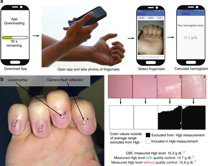 smartphone app detects anemia