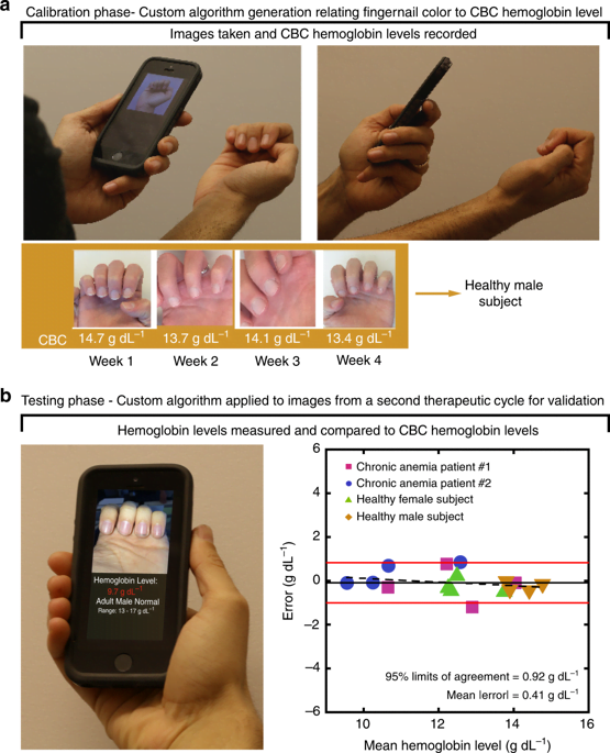 smartphone app to detect anemia